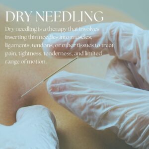 Dry needling acupunture